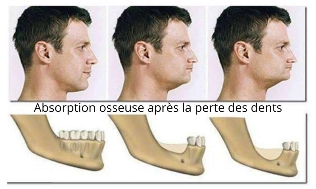 Reabsorção óssea depois da perda de dentes