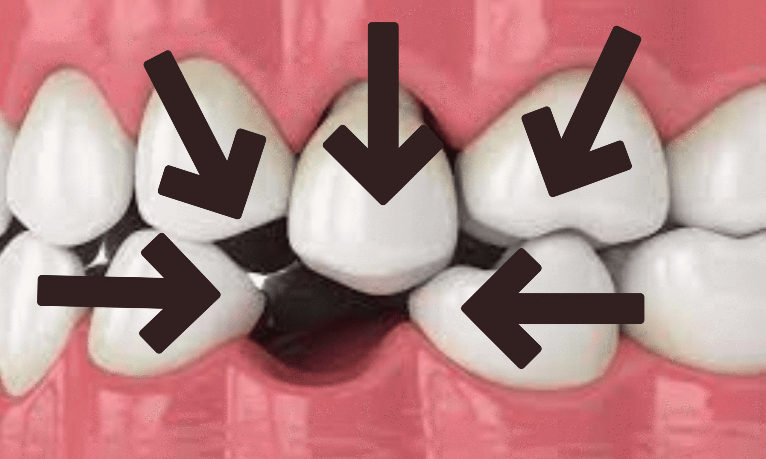 Deslocação dos dentes
