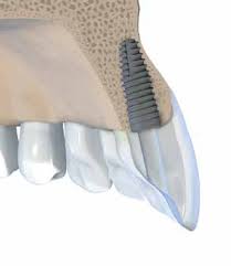 Implantes dentários