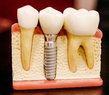 Implantes dentários